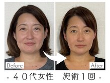 むくみ・たるみ改善/小顔/二重アゴ/むくみ/首肩こり/食いしばり