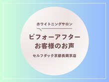 セルフダック 京都長岡京店/ホワイトニングビフォーアフター