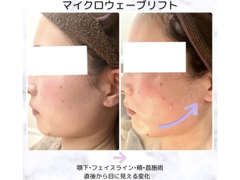 ベルラ(BELLRA)/最先端リフトのマイクロ波