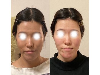 小顔22 ボルティ 赤坂支店(Bolty)/【面長】が大きく変化（6ヶ月）