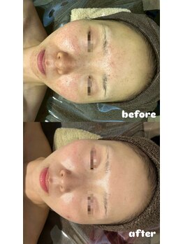 エクラ(ECLAT)/レストセルトリートメント