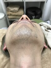 ナノハナ/鹿沼市の全身脱毛のナノハナ