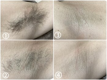 プルーラントエステ キョウト ビジョーラ(PullulantEsthe Kyoto×BEJORA)/メンズ脇脱毛