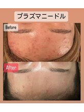 ハイコガオ(HIKOGAO)/プラズマ