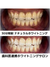 プラチナムビューティ 四条烏丸店(PLATINUM Beauty)/ホワイトニングビフォーアフター