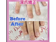 ネイルミュージアム(Nail Museum)/【ハンド】深爪矯正