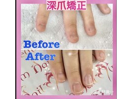 【ハンド】深爪矯正