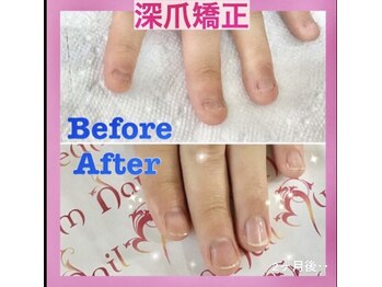 【ハンド】深爪矯正