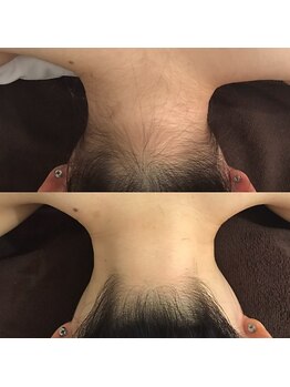 ファイブポイント(FIVE POINT)/うなじ脱毛にこだわってます★