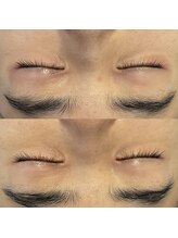 リリアス(RILLIAS)/1年間続いた目周りのかぶれ