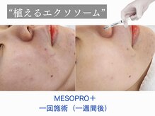 植えるエクソソームで赤み・毛穴改善改善◎疲れ切ったお肌に◎