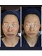 ソルテケア(SORTE*care)の写真/憧れの小顔はπフェイシャル美顔マジックで◎剥離なしピーリングが叶える透明感！ 