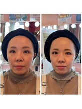 ワイズサロン(Y's salon)/フェイシャルの症例4