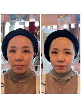 ワイズサロン(Y's salon)/フェイシャルの症例4