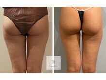 レミュ(Remu)/脂肪燃焼液10ml