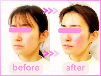 ホリハ整体院/*Before&After* 幹細胞美容鍼