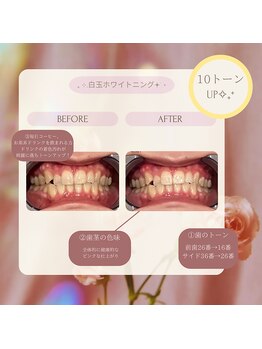 プラスビー 2号店(+b)/ホワイトニングビフォーアフター