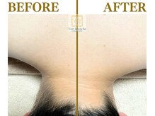 ヴェールブランシュ 町田(Vert Blanche)/#ブライダルエステ#シェービング