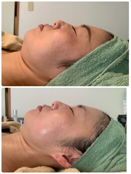 ルーチェ(LUCE)/小顔リフトUP/小顔矯正/筋膜