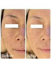 ミミー/美肌菌ピーリング