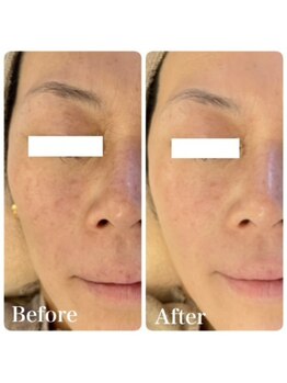 ミミー/美肌菌ピーリング