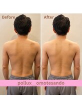 ポルクス鍼灸整骨院 表参道(Pollux鍼灸整骨院)/EMS ビフォーアフター
