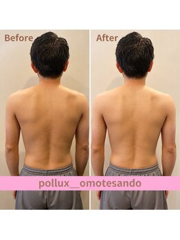 ポルクス鍼灸整骨院 表参道(Pollux鍼灸整骨院)/EMS ビフォーアフター