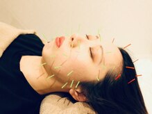 クマノミ美容鍼灸 北浦和院(KUMANOMI美容鍼灸)の雰囲気（ツボを押さえた鍼施術は即効性◎）