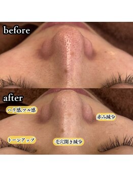 ニューズビューティー(neu's beauty)/フェイシャル × ピーリング♪