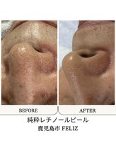 フェリス(FELIZ)/毛穴の開きを引き締める