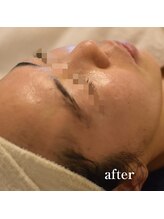 ココルーネ(COCORUNE)/シルク肌ハーブピーリング