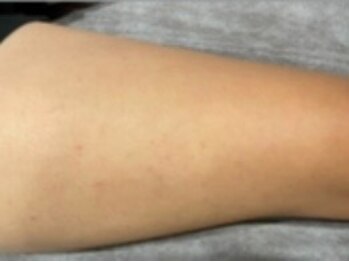 ヨハク(YOHAKU)/20代後半　男性　７回施術after