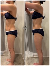 ミロワール(Miroire)/部位集中キャビテーション