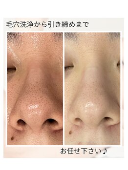 リヴェーヌ 呉羽店(Riverne)の写真/[黒ずみ/毛穴の詰まり/開き]セルフケアでは届かない毛穴汚れもマシンでごっそり☆プロにお任せ！