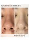 リヴェーヌ 呉羽店(Riverne)の写真/[黒ずみ/毛穴の詰まり/開き]セルフケアでは届かない毛穴汚れもマシンでごっそり☆プロにお任せ！