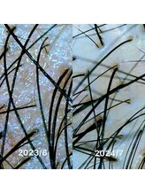 リリーボーテ 下北沢/ 頭皮ケアの成果