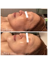 ソーレ(Sole)/《REVI》陶肌トリートメント