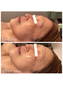 ソーレ(Sole)/《REVI》陶肌トリートメント