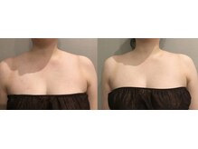 サンサン(SunSAn)/ブライダル痩身