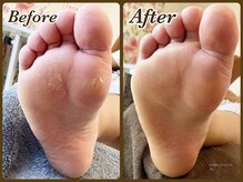 ビューティースパ(Beauty-Spa)/【硬く厚い足裏の角質除去】