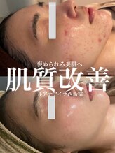 ルアナアイナ(Luana Aina)/ハーブピーリングでニキビケア