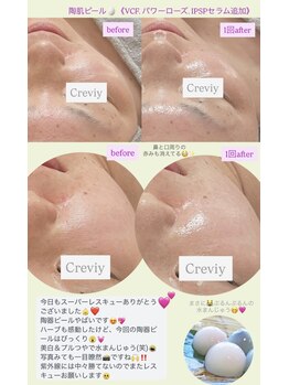 クレヴィー(Creviy)/陶肌ピール1回
