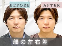エルシンメトリー矯正院(ailesシンメトリー矯正院)/before&after　小顔