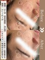 ファッショニスタ 恵比寿東口(Fashionista) 【メニュー:スノピール/期間:3カ月/悩み:ニキビの赤み】
