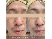 メンズフェイシャルエステで男のモテ肌作り一緒にしませんか？