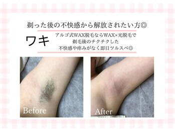 アルゴ 熊本玉名店(ALGO)/【ワキ】不快感や痒みから解放☆