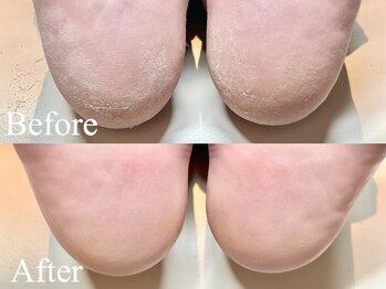 グランジーナ(Gran Jiina)/フット角質ケア