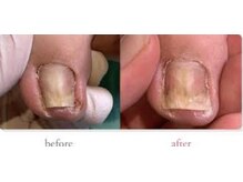 巻き爪矯正で爪の圧迫が取れ痛みも軽減◎歩きやすさに感動！