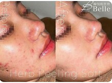 ベル 代々木店(Belle)/ニキビケア施術例