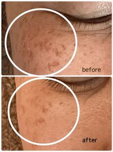 エステティックジュビラン アンビエンテ 福井南店/シミケア